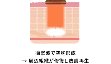 ハリウッドフラクショナル｜当院オリジナルの治療。シミ・くすみ・毛穴の開き・ニキビ跡・肌のハリ・ツヤなど、様々な肌トラブルを改善し、ジュエルのような輝きを取り戻すことが期待できる、美肌と美白を兼ね備えた治療